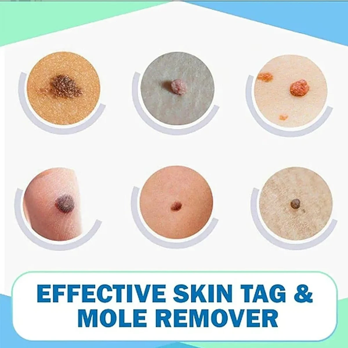 Skin Tags & Moles Remover,Wipe Off Tags