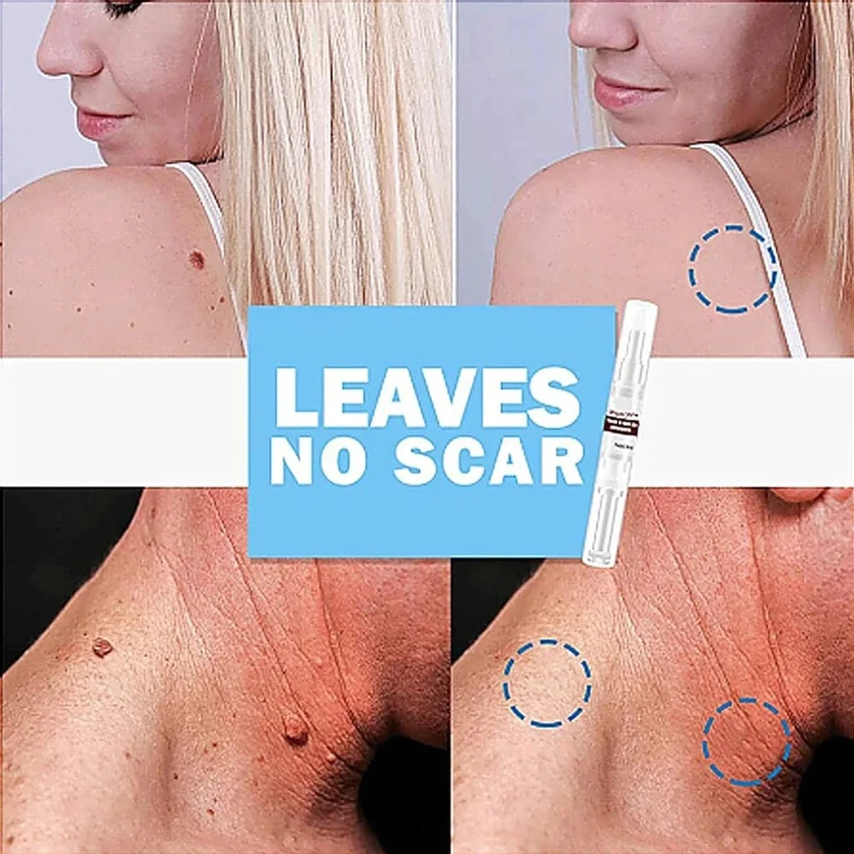 Skin Tags & Moles Remover,Wipe Off Tags